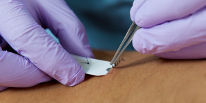 Image of sutures being removed using forceps and SutureOut tool.